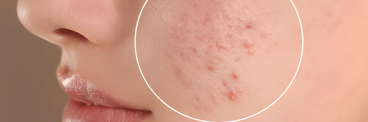 Acne And Acne Scar Treatment