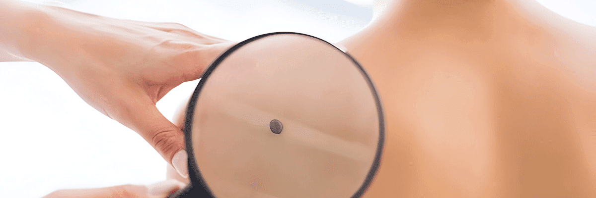 Birthmark Treatment